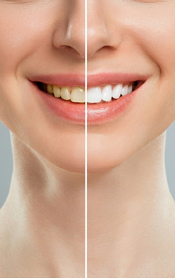 Teeth Whitening