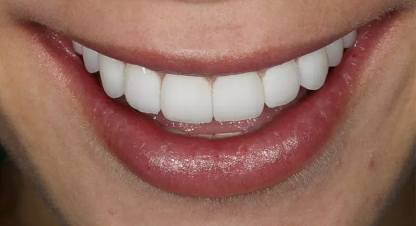 image after
