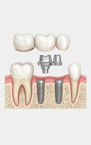 Protheses Dentaires