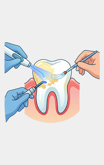 Blanchiment des dents
