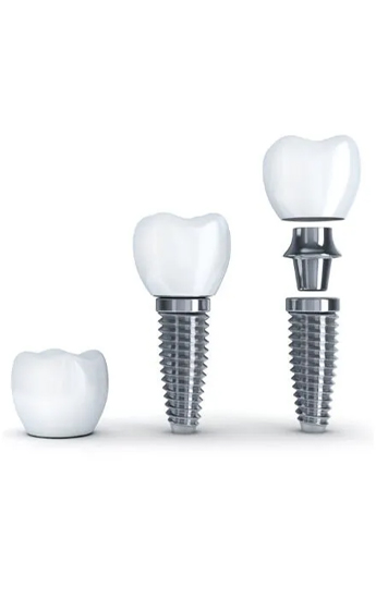 Dental Implants