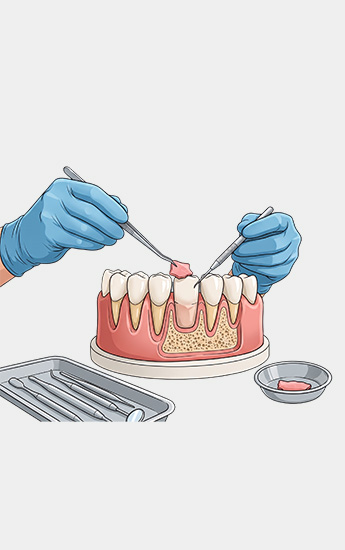 Greffes gingivales